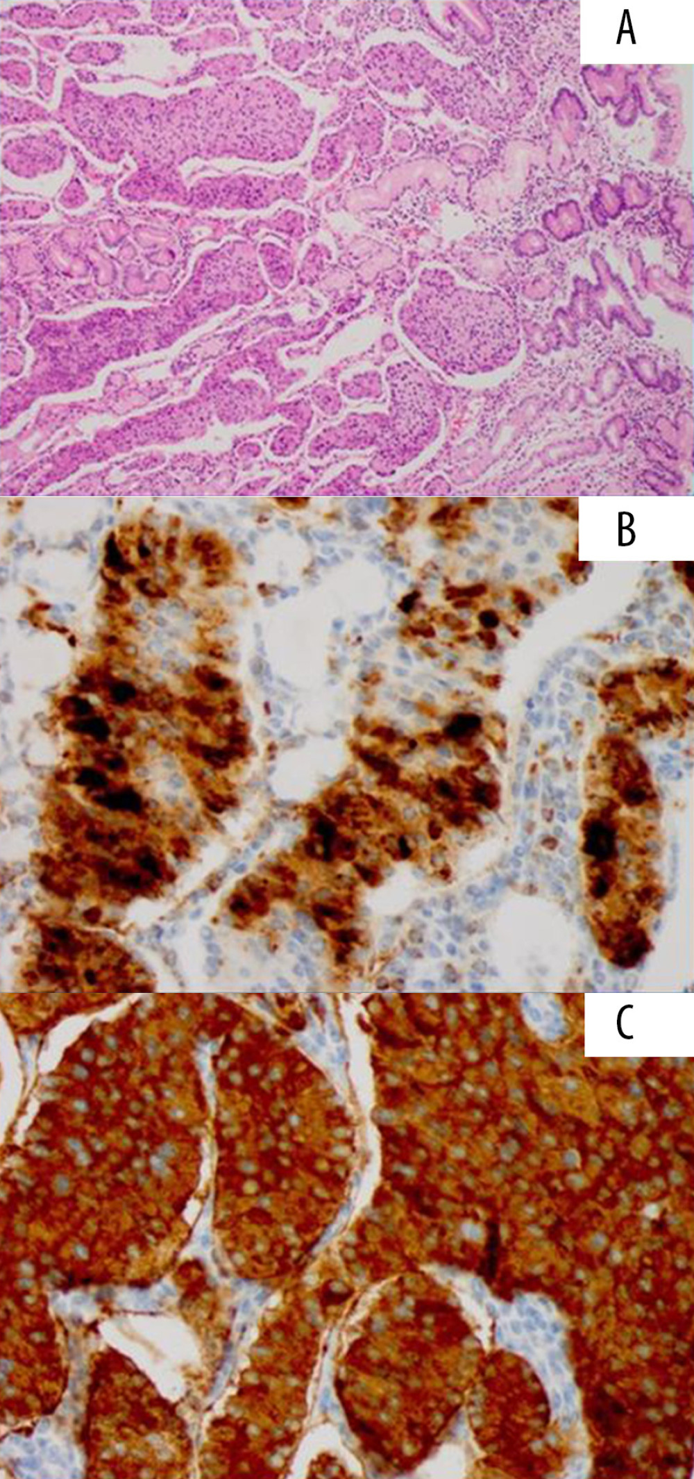 Hematoxylin and eosin staining of tumor invasion in the duodenum (original magnification ×100) (A). On immunohistochemistry, the main tumor cells stained positive with chromogranin A (B) and synaptophysin (original magnification ×200) (C).