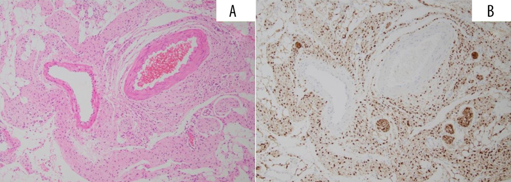 Hematoxylin and eosin staining (A) and S-100 immunoperoxidase (reddish-brown) staining (B) of the neurofibroma cells spreading around the vessel wall (original magnification ×100).