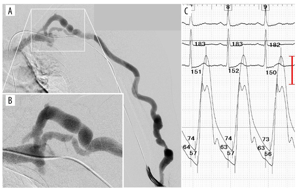 (A) Controlled digital subtraction angiography of the left upper limb. (B) A magnified image of the distal site of the vascular access vein. (C) Simultaneous measurement of blood pressure in the brachial artery and the vascular access vein before the endovascular treatment.