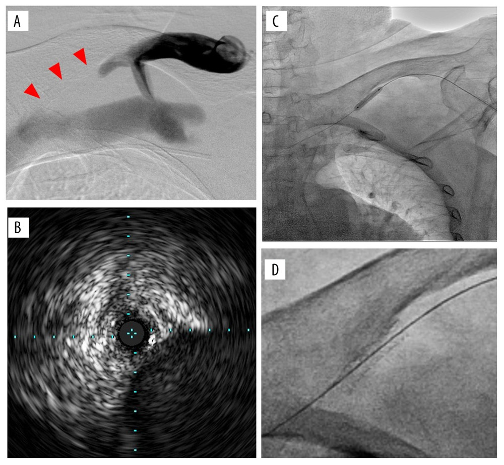 The endovascular treatment for a branch occlusion of the axillary vein. (A) The most proximal vessel out of 3 branches was occluded just before the junction to the subclavian vein (arrowheads). (B) An intravascular ultrasound showing an intimal thickening with fibrous plaques in the entire circumference of the occlusion. (C) Deployment of a balloon-expandable bare-metal stent. (D) A magnified image of the implanted stent.
