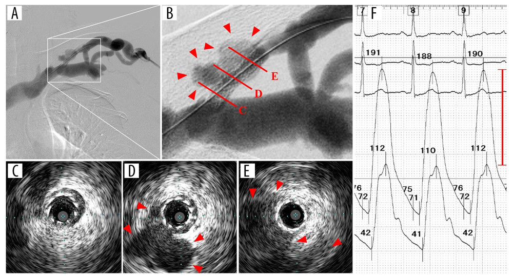(A) Good vascular patency with favorable blood flow in the final digital subtraction angiography. (B) A magnified image of the treated lesion. Varices-like formations were observed (arrowheads). (C–E) Cross-sectional intravascular ultrasound images after stent implantation. These C–E images correspond to the cross-sections in Figure 3B. An enlarged luminal space spreading externally beyond the stent’s luminal area (arrowheads). (F) Simultaneous measurement of blood pressure in the brachial artery and the vascular access vein after the endovascular treatment.