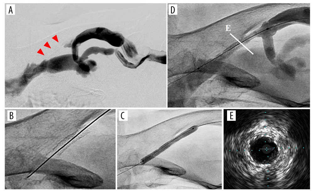 (A) In-stent total occlusion at the junction with the subclavian vein 6 months after the initial endovascular treatment (arrowheads). (B) Stent fracture was not apparent. (C) A 4.0-mm scoring balloon inflated in the occluded stent. (D) Final angiography showed a favorable lesion dilation and the recovered blood flow. (E) A cross-sectional intravascular ultrasound image corresponding to the section in Figure 4D.