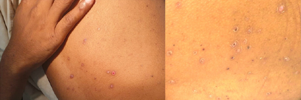 Maculopapular rash and mature vesicles with crusting.