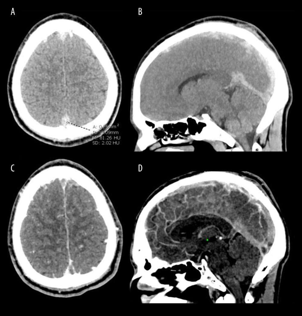 Unenhanced CT brain and contrast-enhanced CT venography. (A) Axial and (B) midline MIP sagittal images from unenhanced CT show hyperdense superior sagittal sinus (CT density of about 80 Hounsfield units), straight sinus and bilateral frontal parasagittal cortical veins concerning for thrombosis. (C) Axial and (D) midline sagittal CT venography images confirm filling defects in the cerebral dural venous sinuses and cortical veins indicative of thrombosis. Thrombosis extended into the transverse and sigmoid sinuses and left internal jugular vein (not shown).