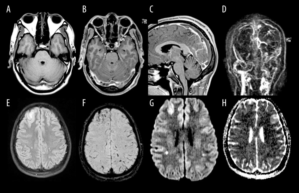 MRI brain including contrast-enhanced MR venography. (A) Axial T1-weighted pre-contrast image shows signal in bilateral transverse sinuses isointense to grey matter. (B) Axial and (C) sagittal T1-weighted post-contrast images confirm filling defects within bilateral transverse sinuses, superior sagittal sinus, and straight sinus. (D) Coronal and (H) sagittal MIP images from MR venography demonstrate extensive thrombosis of the dural venous sinuses extending into the left internal jugular vein. (E) FLAIR image shows small area of cortical and subcortical edema in the right frontal lobe, with presence of microhemorrhages at this site on SWI (F). (G) DWI images show small foci of diffusion restriction within the temporoparietal white matter bilaterally, compatible with acute lacunar infarcts.