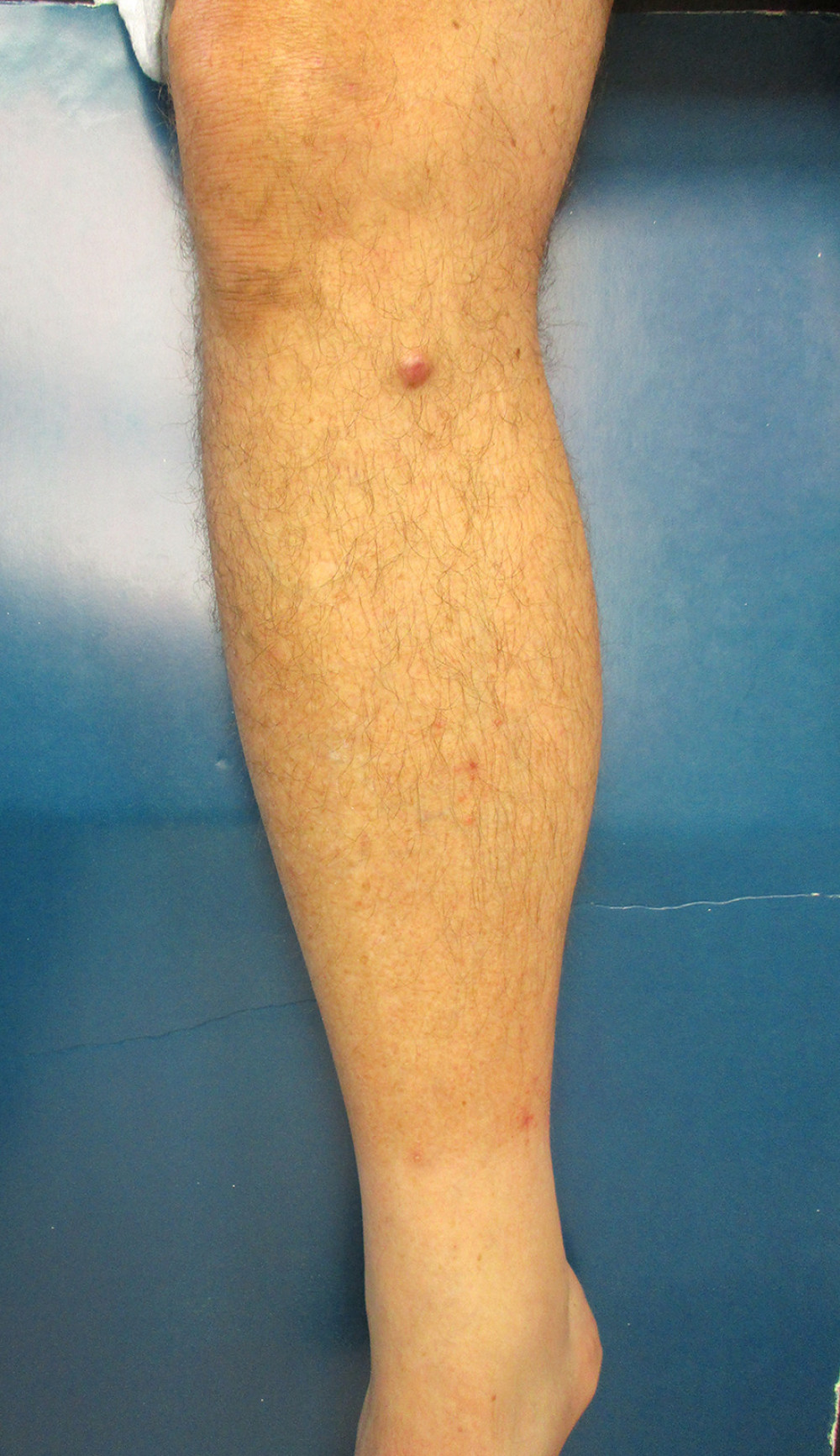 Asymptomatic lesion on the lower leg.