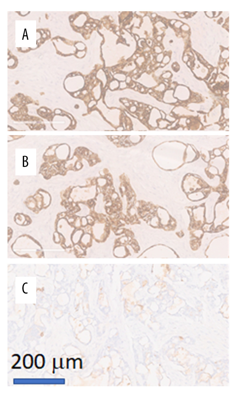 Immunohistochemical staining features of primary cutaneous cribriform apocrine carcinoma. Tumor cells are immunoreactive for (A) cytokeratin 7 and (B) high-molecular-weight keratin, and (C) focally reactive for CEA.