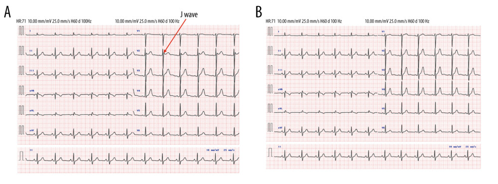 (A) Twelve-lead electrocardiogram (ECG) of the patient taken approximately 1 year before the operation. The ECG is normal: There are no J waves in V2. (B) Twelve-lead electrocardiogram (ECG) of the patient taken 1 week before the operation. The ECG changes clearly from the ECG 1 year ago. The arrow shows the saddle-back-type J waves in V2 (>2 mm) and ST increase (>1 mm), indicating that the patient has a type II Brugada syndrome ECG.
