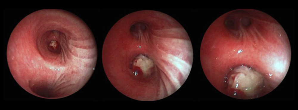 Images corresponding to fiberoptic bronchoscopy with an endoluminal tumor in the intermediate bronchus that creates complete bronchial obstruction.