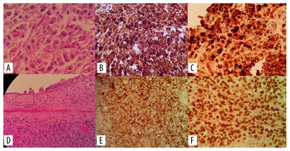 (A) Malignant epithelioid-like tumor cells with prominent nucleolus, compatible with endobronchial malignant melanoma. Hematoxylin-Eosin staining on initial biopsy. (B) Tumor cells positive for HMB 45 on initial biopsy. (C) Tumor cells positive for S100 on initial biopsy. (D) Hematoxylin-Eosin staining of the surgical specimen. (E) Tumor cells positive for Melan A. (F) Tumor cells positive for SOX 10. All pathology images are 40× magnification, except for images D and E, which are 10×.