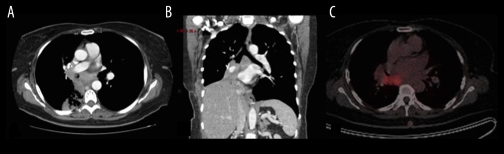 (A, B) In the axial image and the coronal reconstruction of the chest tomography with contrast, a mass with a soft tissue density is observed, which completely compromises the lumen of the intermediate bronchus and the right lower lobar, and partially compromises the lumen of the middle lobar bronchus with associated post-obstructive atelectasis. (C) Positron emission tomography shows the hypermetabolic mass of poorly defined margins, located in the upper segment of the right lower lobe, approximately 59×59×81 mm (APxTxL) (max SUV 18.6).