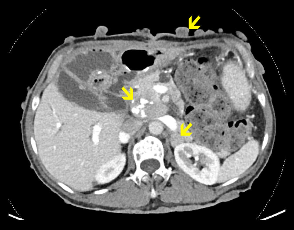 Computed tomography scan of the abdomen, showing a 1.7-cm left adrenal mass, a 3.7-cm pancreatic mass with partial calcification, and 1 of numerous cutaneous neurofibromas (annotated in yellow).