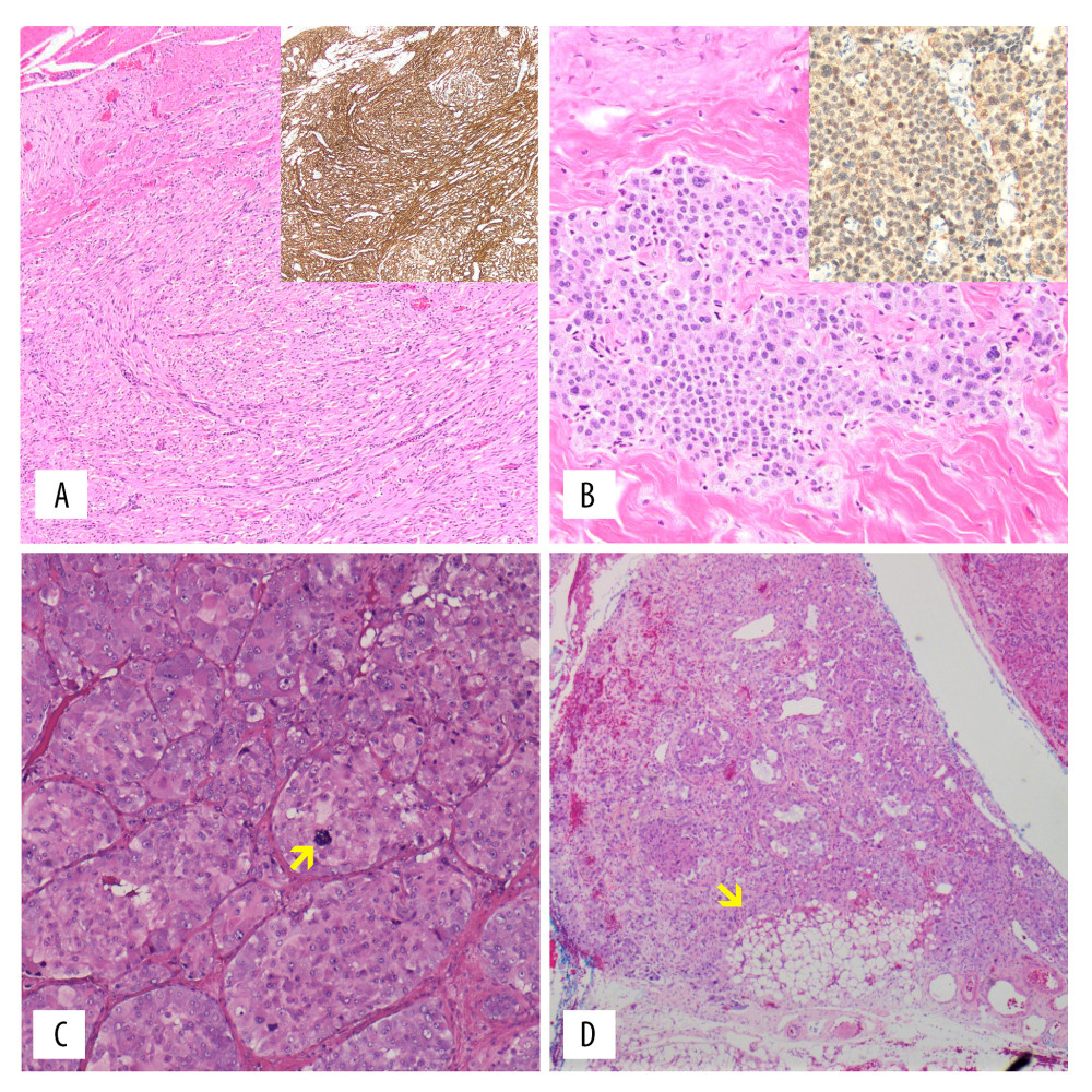 Histopathologic features of GIST, gastrinoma, and pheochromocytoma. Hematoxylin-eosin (H&E) and immunohistochemical staining were performed for c-KIT (CD117) and gastrin. (A) Histological section (H&E) of the jejunal GIST showing tumor cells with a fibrous stromal pattern, inset c-KIT/CD117 staining (acquired 20×); (B) Histological section (H&E) of the neuroendocrine tumor showing sheets of bland cells, inset gastrin staining (acquired 40×); (C) Histopathology (H&E) of pheochromocytoma showing polygonal cells in a nest pattern (acquired 40×), atypical mitosis annotated (yellow); (D) Histopathology (H&E) of pheochromocytoma showing invasion of peri-adrenal adipose tissue invasion (yellow).