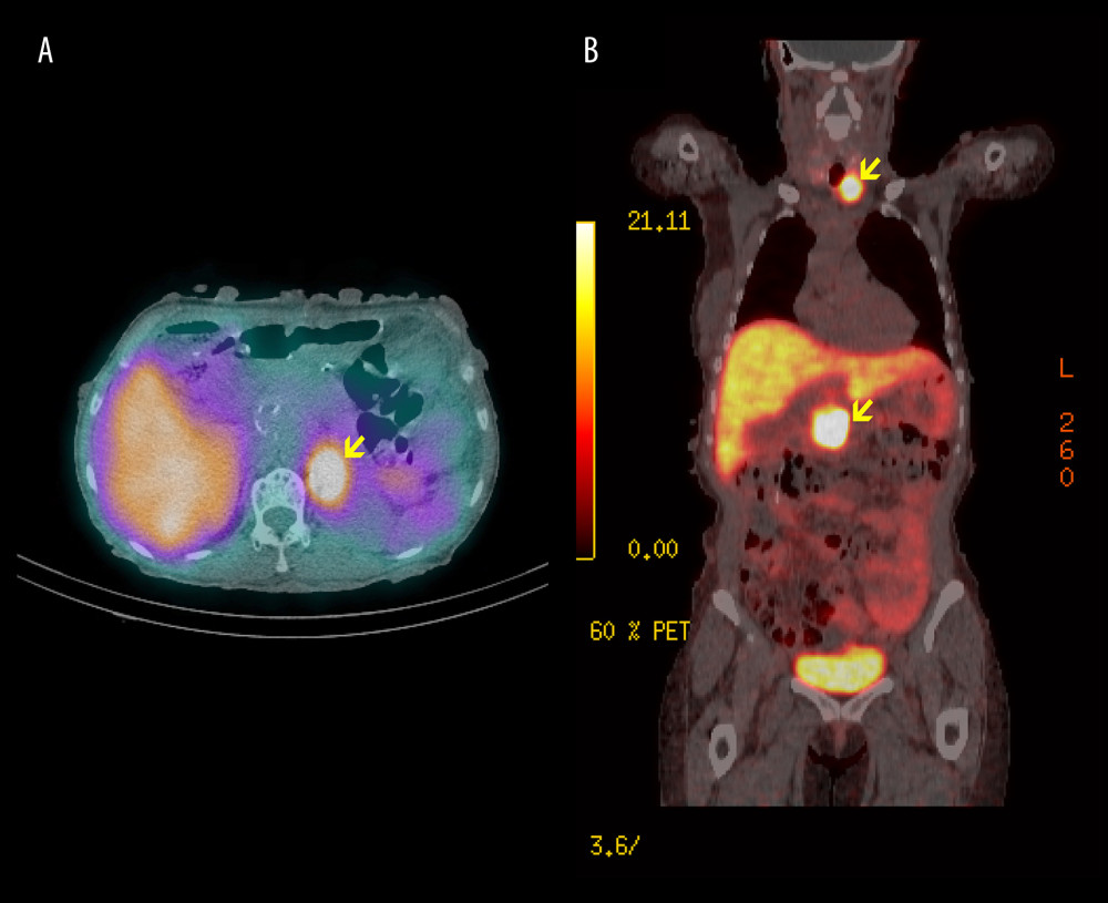 Functional and nuclear imaging. (A) I123 MIBG SPECT/CT axial image of the abdomen showing an MIBG avid nodule correlating to the left adrenal mass. (B) 68Ga-DOTATOC PET/CT coronal section showing DOTATOC avidity in the pancreatic head and a left thyroid nodule (yellow arrows).