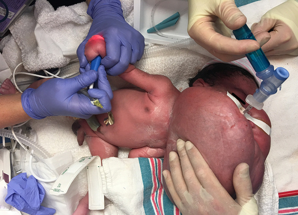 Delivery of an infant at 37 weeks’ gestation with airway obstruction due to cystic hygroma. The infant is shown at delivery following airway intubation. A large cystic hygroma of the neck is shown, measuring 20.1×9.7×18.2 cm by ultrasound.