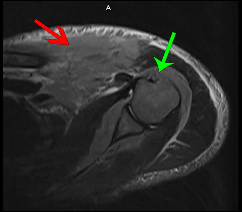 Magnetic resonance imaging of the left shoulder: soft tissue component of the mass (red arrow) and infiltration of the mass into the bone marrow (green arrow).