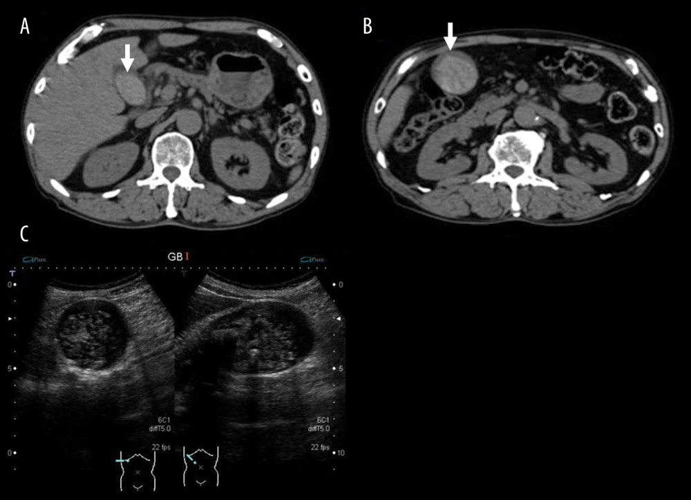 Imaging findings of abdomen at admission. (A, B) Non-contrast CT showed hyperdense materials in the wall-thickening gallbladder (arrow) and no ascites. (C) The abdominal ultrasound demonstrated distended gallbladder with stones, echogenic materials, and a thickened wall.