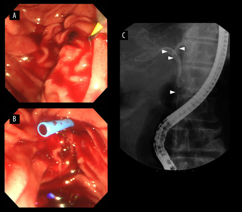 Results of ERCP. (A) Duodenoscopy showed blood around the duodenal papilla. (B) Cannulation led to the flow of old blood and clots from the common bile duct. (C) On cholangiography, many defects were observed in the common bile duct (arrowheads).