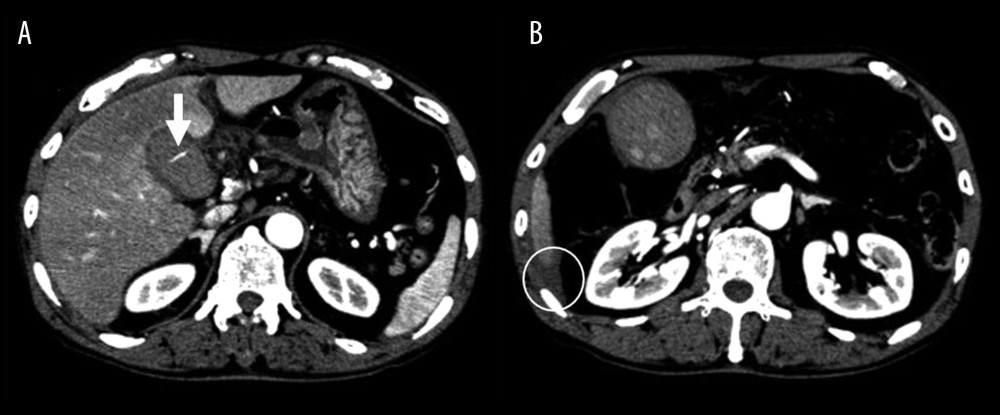 Contrast CT scan: An arterial-phase contrast CT scan revealed extravasation (arrow) into the gallbladder lumen (A) and fluid accumulation on the Morison fossa (circle) (B).