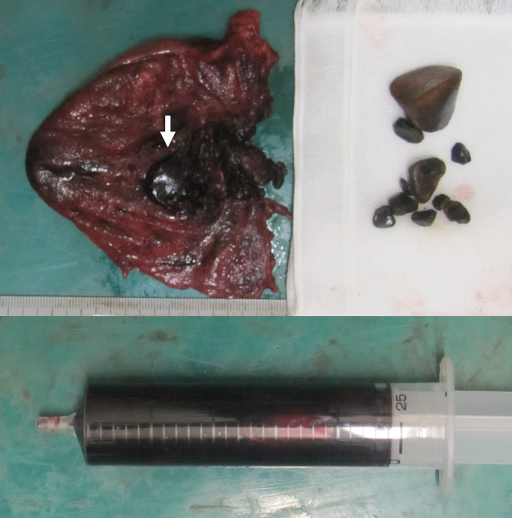 Photo of the gallbladder specimen showing dark blood, clots, and gallstones in the gallbladder. The ulcer (arrow) is formed on the mucosal side.