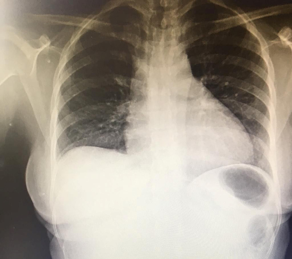 Chest X-ray at the time of admission showing borderline cardiomegaly with clear lung fields.