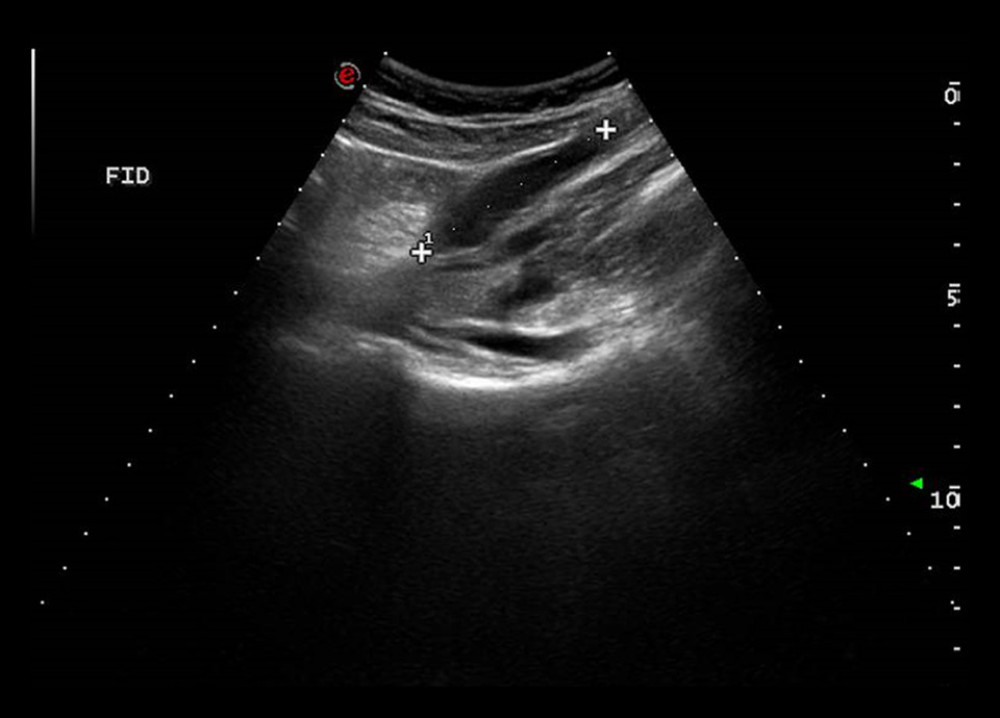 Abdominal ultrasound showing an appendix 5.5 cm long, dilated, and distended by an anechogenic material with wall thickening.