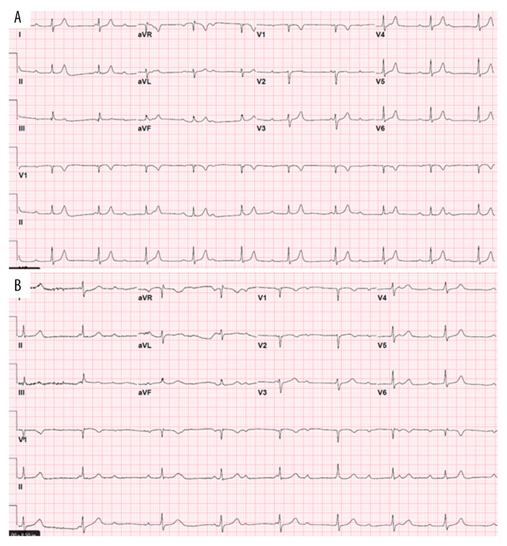 (A) EKG at admission showing complete heart block. (B) EKG 12 h after admission showing complete heart block.