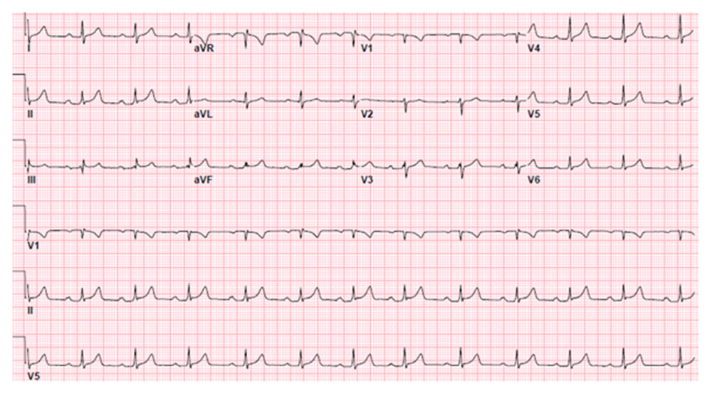 EKG on day 7 showing sinus rhythm with first-degree AV block with a PR duration of 210 ms and a ventricular rate of 74/min.