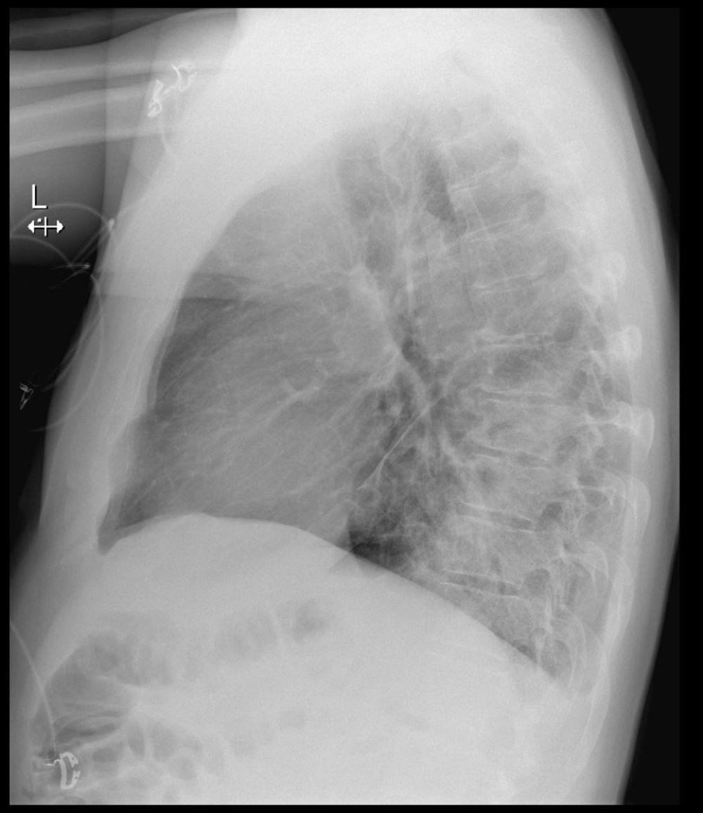 Lateral chest X-ray demonstrating a retrocardiac consolidation of the left lower lobe.