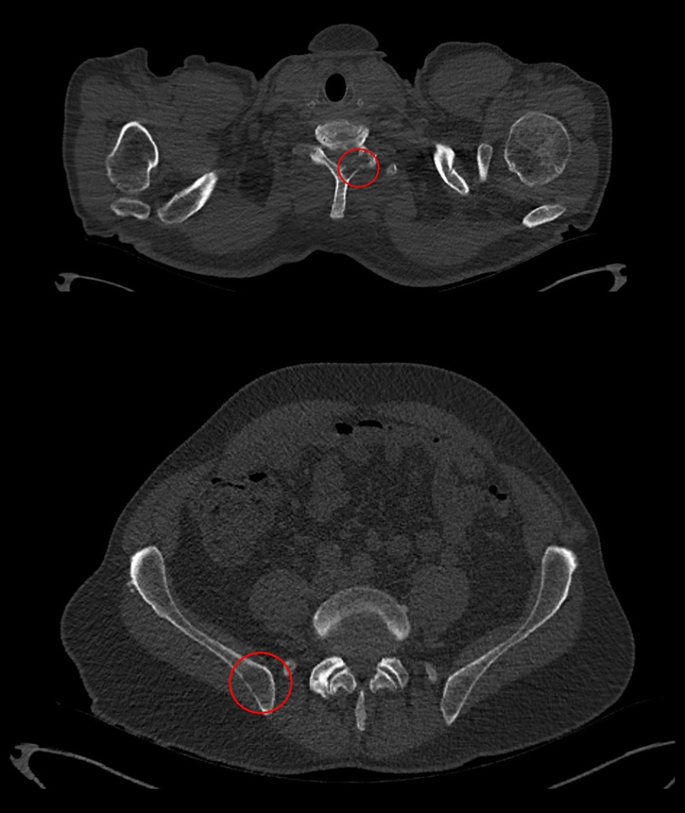 Whole-body low-dose computed tomography scan showing an osteolytic bone lesion in the seventh cervical vertebra and the right pelvis (red circles).