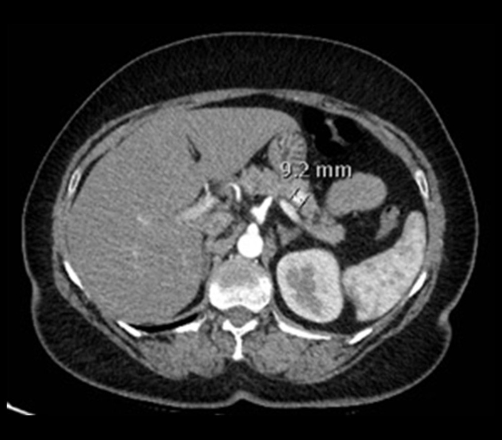 Abdominal CT scan showing the metastatic lesions within the pancreas.