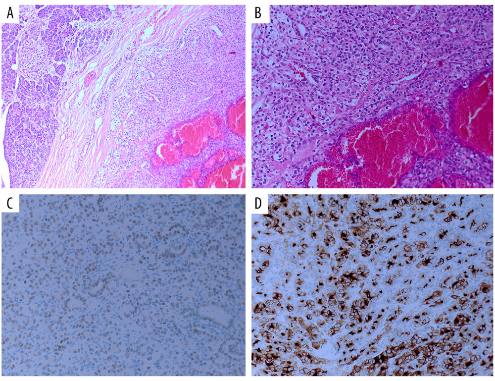 (A, B) Microscopic picture with H&E showing the renal cell carcinoma metastasis within the pancreatic tissue. (C) Immunohistochemistry staining of the resected lesion from the pancreas showing positive PAX 8. (D) Immunohistochemistry staining of the resected lesion from the pancreas showing positive CD-10.