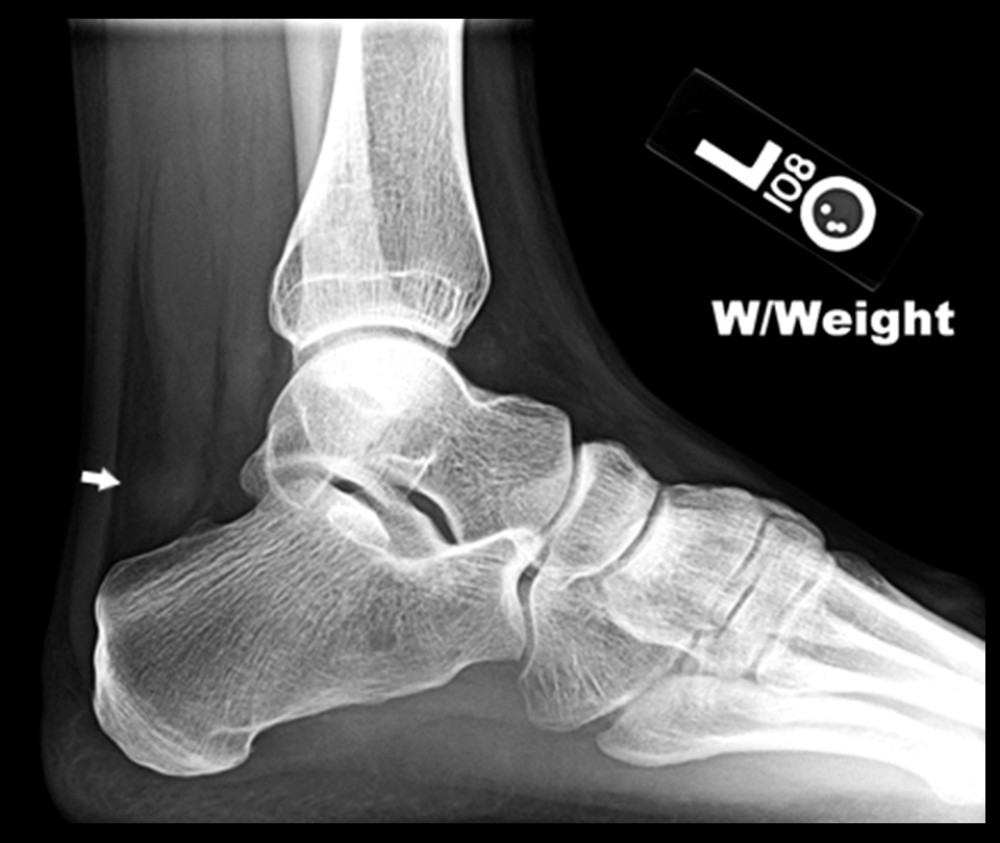 Lateral radiograph of the left ankle demonstrating radiographic features of a benign nerve sheath myxoma prior to resection. This radiograph demonstrates a nonspecific soft-tissue density posterior to the talus (arrow).