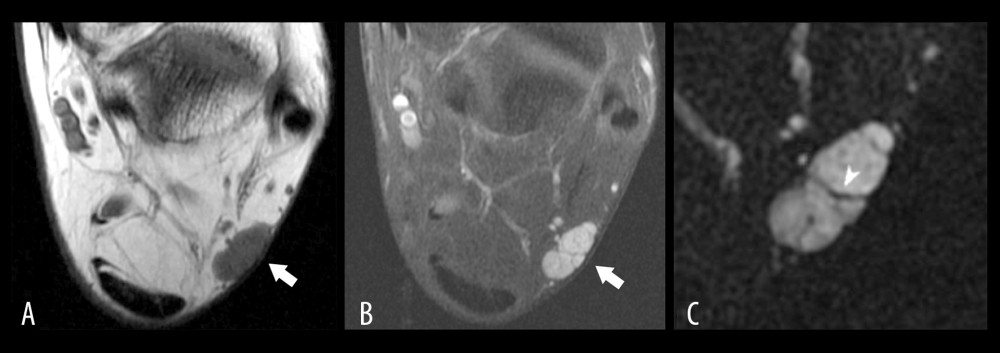 Magnetic resonance images of a nerve sheath myxoma within the posterolateral left ankle prior to resection: (A) axial T1, (B) axial T2 post-contrast, (C) axial T2 magnified image. (A) Axial T1 magnetic resonance image shows an intermediate signal dermal-based lobular mass in the posterolateral ankle subcutaneous fat opposed to the dermis. (B) Axial T1 fat saturation gadolinium post-contrast image shows diffuse mass enhancement with non-enhancing thin septae. (C) Magnified axial fat saturated T2 magnetic resonance image demonstrates septae to better advantage (arrowhead).