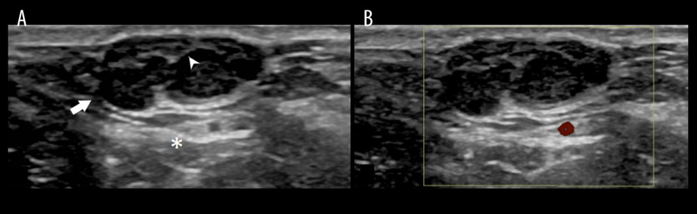 Ultrasound images of a lobulated and circumscribed nerve sheath myxoma of the left ankle with and without doppler interrogation prior to resection. (A) Longitudinal image shows a lobulated, circumscribed, hypoechoic mass (arrow) associated with the dermis and extending into the subcutaneous fat. There are internal septae (arrowhead) and posterior acoustic enhancement (asterisk). (B) Longitudinal color Doppler image demonstrates no internal vascular flow.