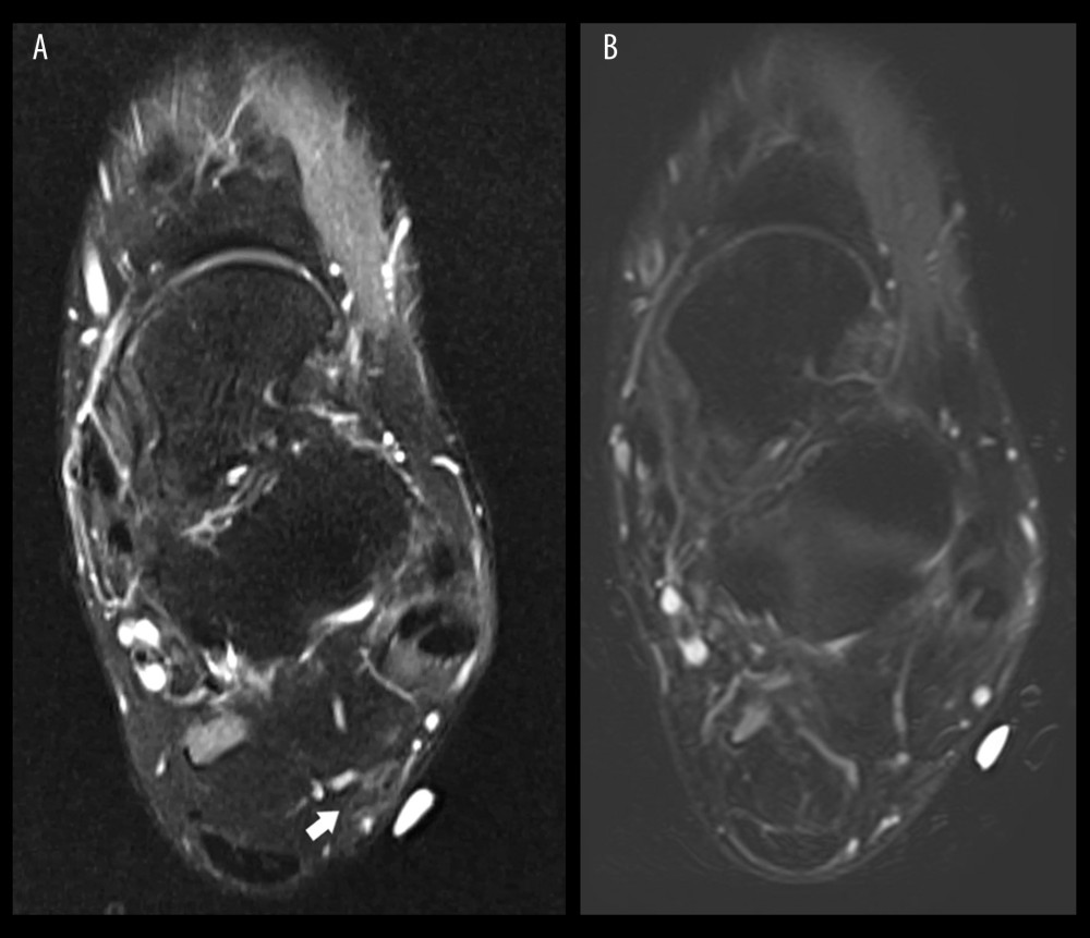 Axial T2 magnetic resonance images of a nerve sheath myxoma of the ankle 6 (A) and 12 months (B) after resection, demonstrating gradual resolution of signal abnormality. (A) Axial T2 fat saturation MR image 6 months after resection with bright surface vitamin E marker shows subtle non-masslike increased T2 signal representative of post-excision granulation tissue (arrow). (B) Axial T2 fat saturation MR image performed 12 months after resection with bright surface vitamin E marker shows no resection bed signal abnormality.