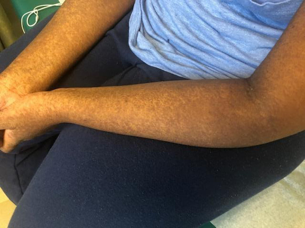 Erythematous papules visible on the patient’s arms.