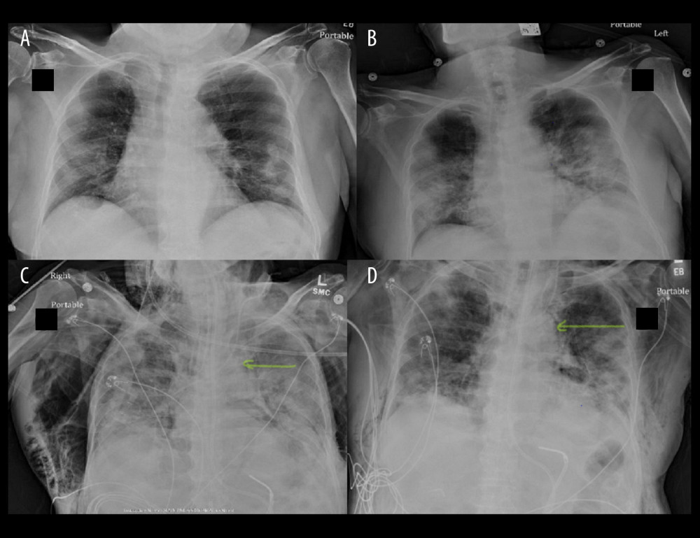Patient 1 chest X-rays. (A) Day 1 of hospital admission – Mild bilateral lung opacities suggestive of infectious process. (B) Day 2 of hospital admission – Worsened bilateral lung opacities. (C) Day 5 of hospital admission – Subcutaneous emphysema and pneumomediastinum (yellow arrows). (D) Day 8 of hospital admission – Significantly improved lung opacities, subcutaneous emphysema and pneumomediastinum (yellow arrows).