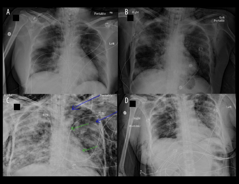 Patient 2 chest X-rays. (A) Day 1 of hospital admission – Bilateral lung opacities suggestive of severe pneumonia. (B) Day 2 of hospital admission – Worsened bilateral opacities with SE and pneumomediastinum. (C) Day 6 of hospital admission – Subcutaneous emphysema, pneumomediastinum and pneumothorax (arrows). (D) Day 9 of hospital admission – Significantly improved lung opacities, subcutaneous emphysema, pneumomediastinum and pneumothorax (arrows).