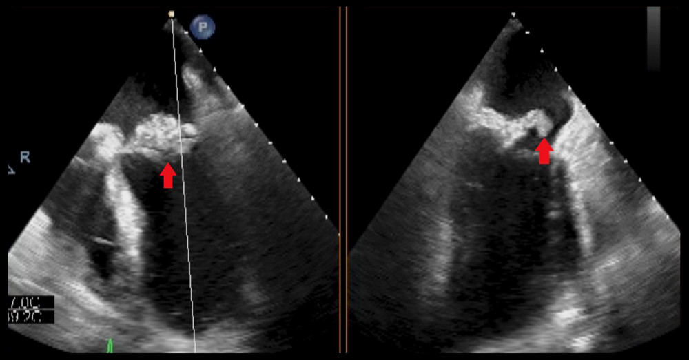 Transesophageal echocardiography showing large vegetation on mitral valve leaflet. A transthoracic echocardiogram showing large vegetation (red arrow) on the leaflet of the mitral valve with evidence of associated leaflet perforation.