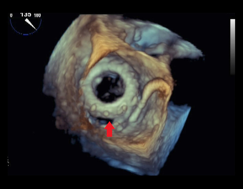 Transesophageal echocardiogram (TEE) showing the mitral paravalvular defect. Transesophageal echocardiogram showing dehiscence of the bioprosthetic mitral valve and annular pericardial patch (red arrow).