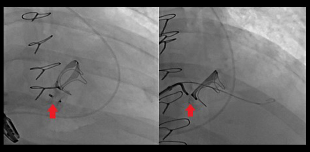 X-ray showing deployment of ventricular septal defect (VSD) occluder. X-ray showing the deployment of the ventricular septal defect occluder (red arrow)