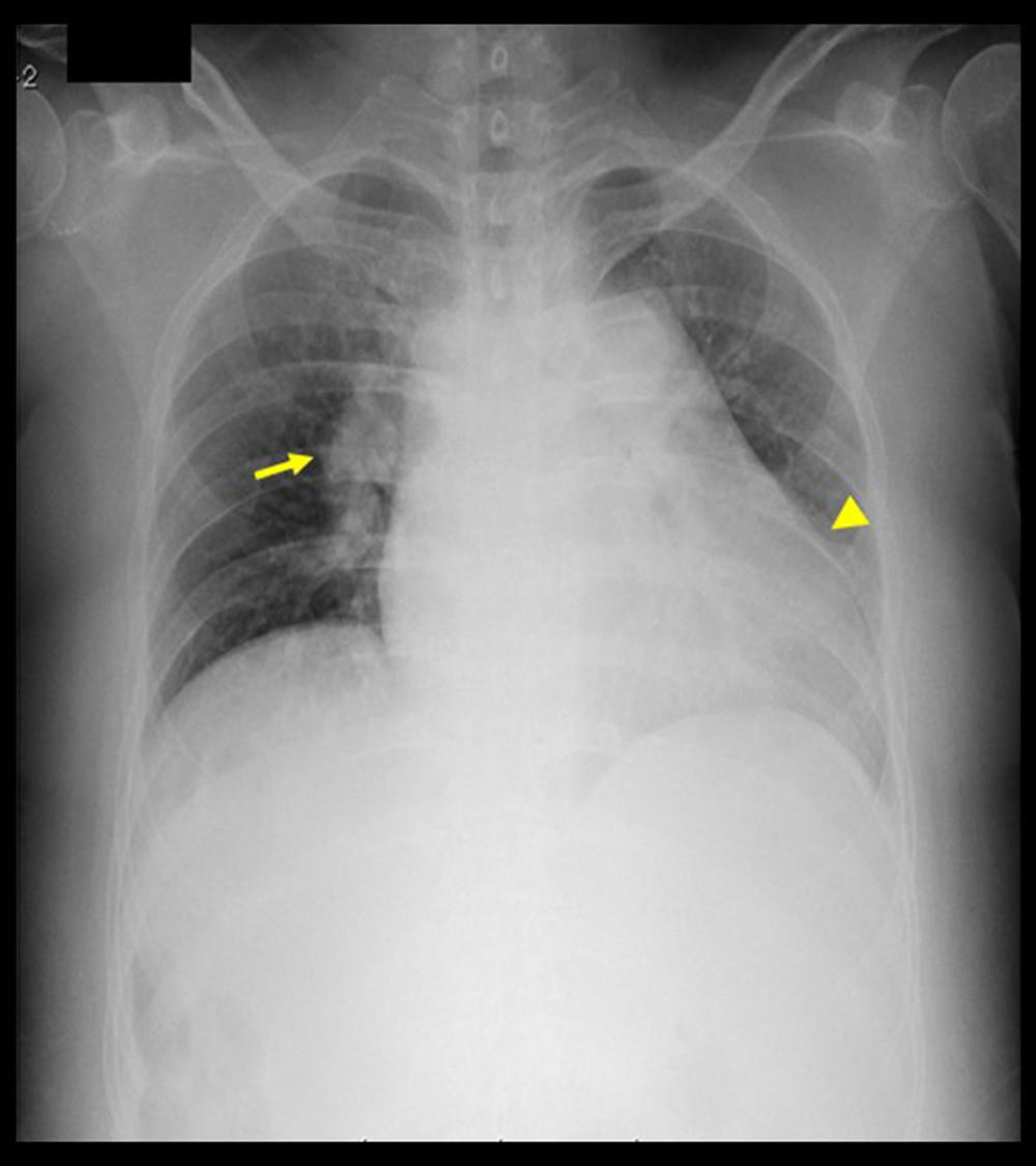 Chest X-ray shows cardiac enlargement (arrowhead) and pulmonary congestion (arrow).