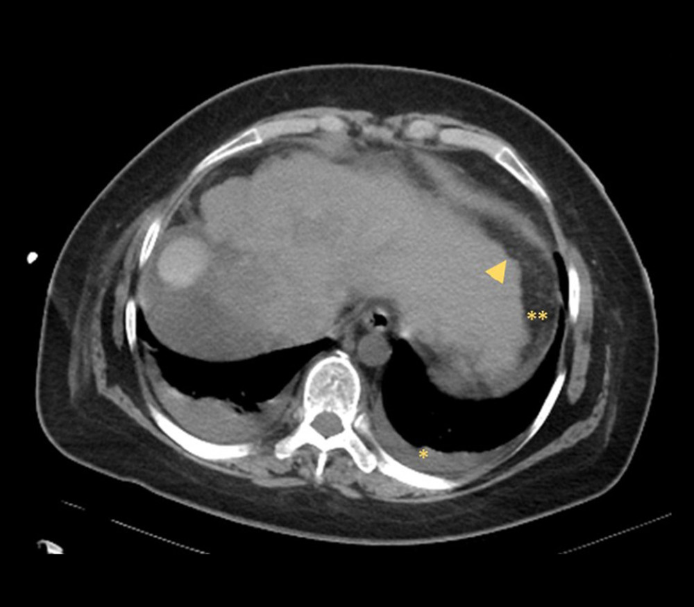 Abdominal image by computed tomography shows atrophy of right lobe and surface irregularity indicating liver cirrhosis (arrowhead) and pleural effusion (star) and ascites (double star).