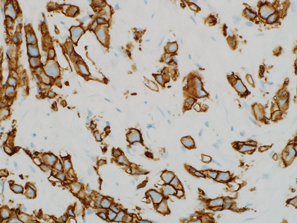 HER-2 immunostain demonstrates intense complete membrane staining of tumor cells indicating HER-2 overexpression (original magnification 40×).