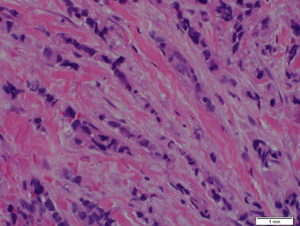 The neoplastic cells infiltrate the stroma singly or in linear strands in pleomorphic variant (hematoxylineosin, original magnification 40×).
