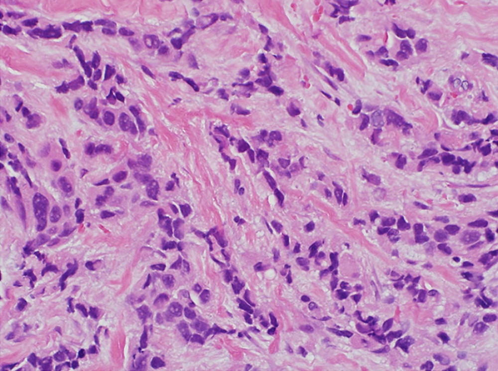 The neoplastic cells exhibit nuclear variation (hematoxylin-eosin, original magnification 40×).