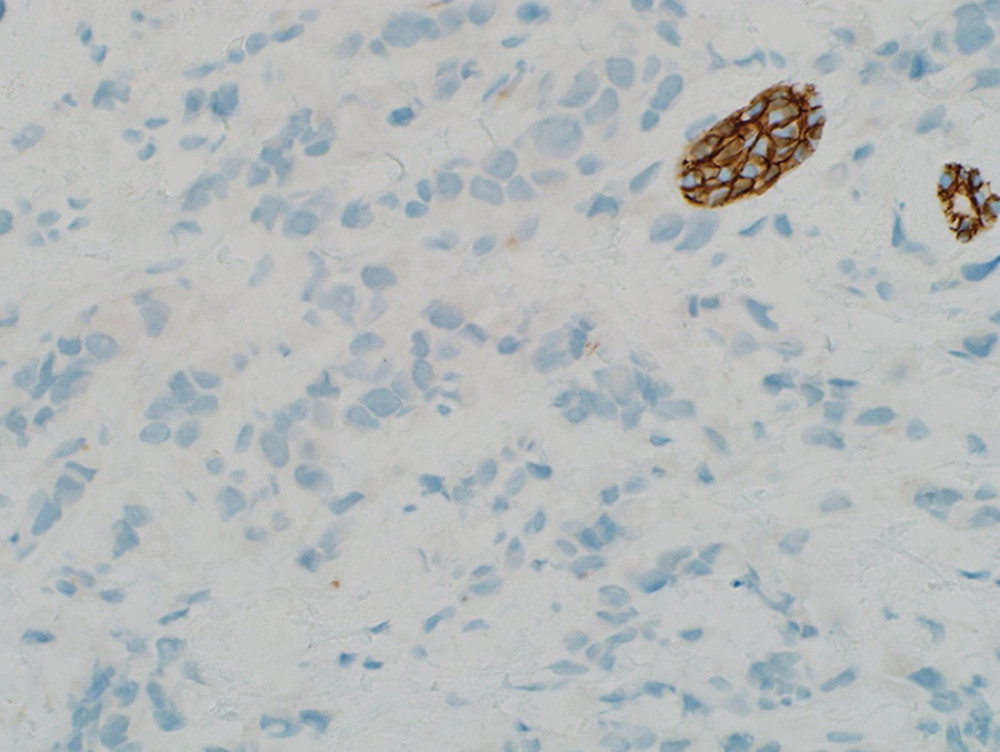 E-cadherin immunostain showing loss of expression in the tumor cells, while the cells of the benign duct show strong membrane staining (original magnification 40×).