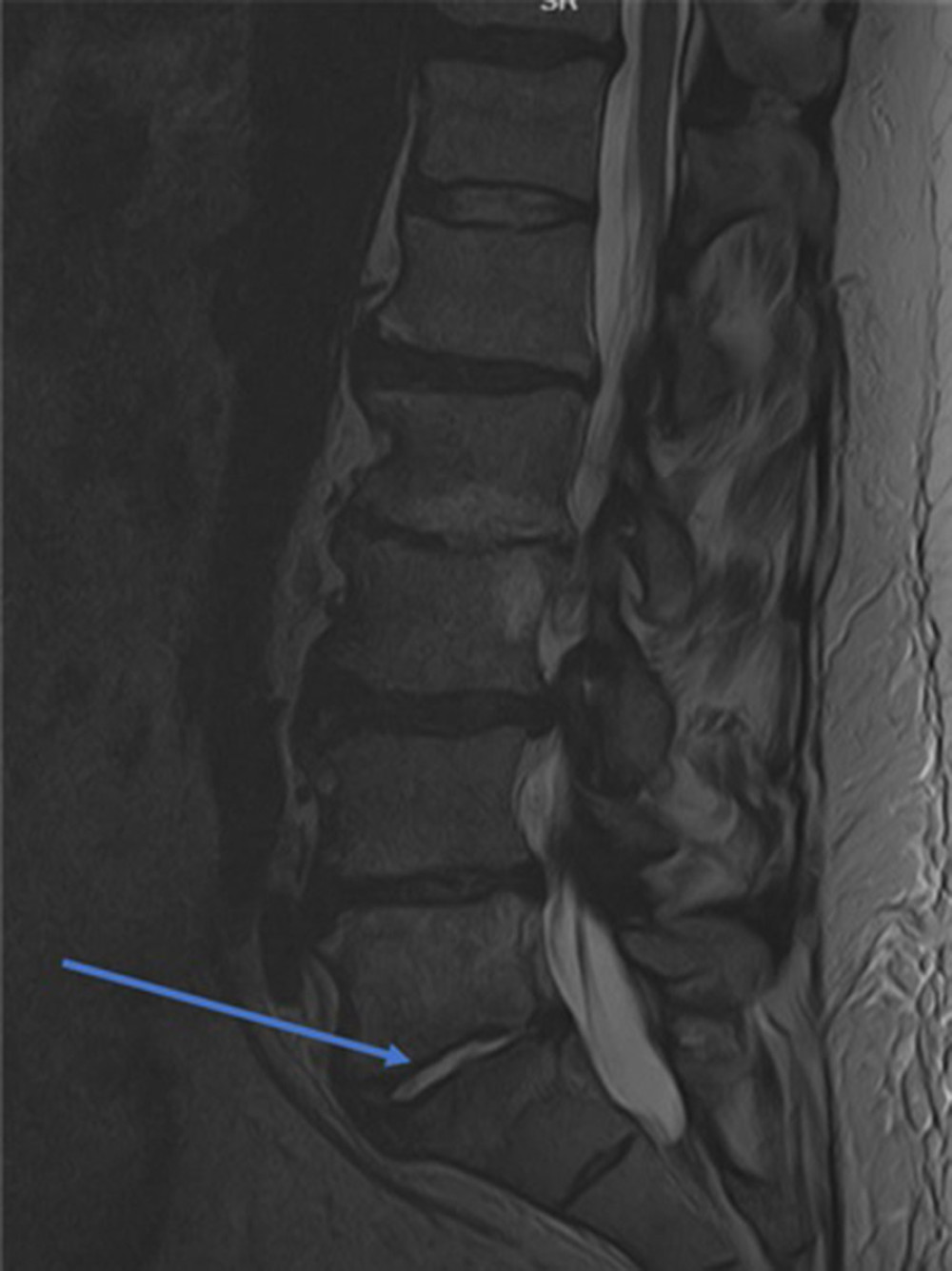MRI of lower lumbar spine demonstrating abnormal enhancement within the L5–S1 disc, consistent with discitis (blue arrow).