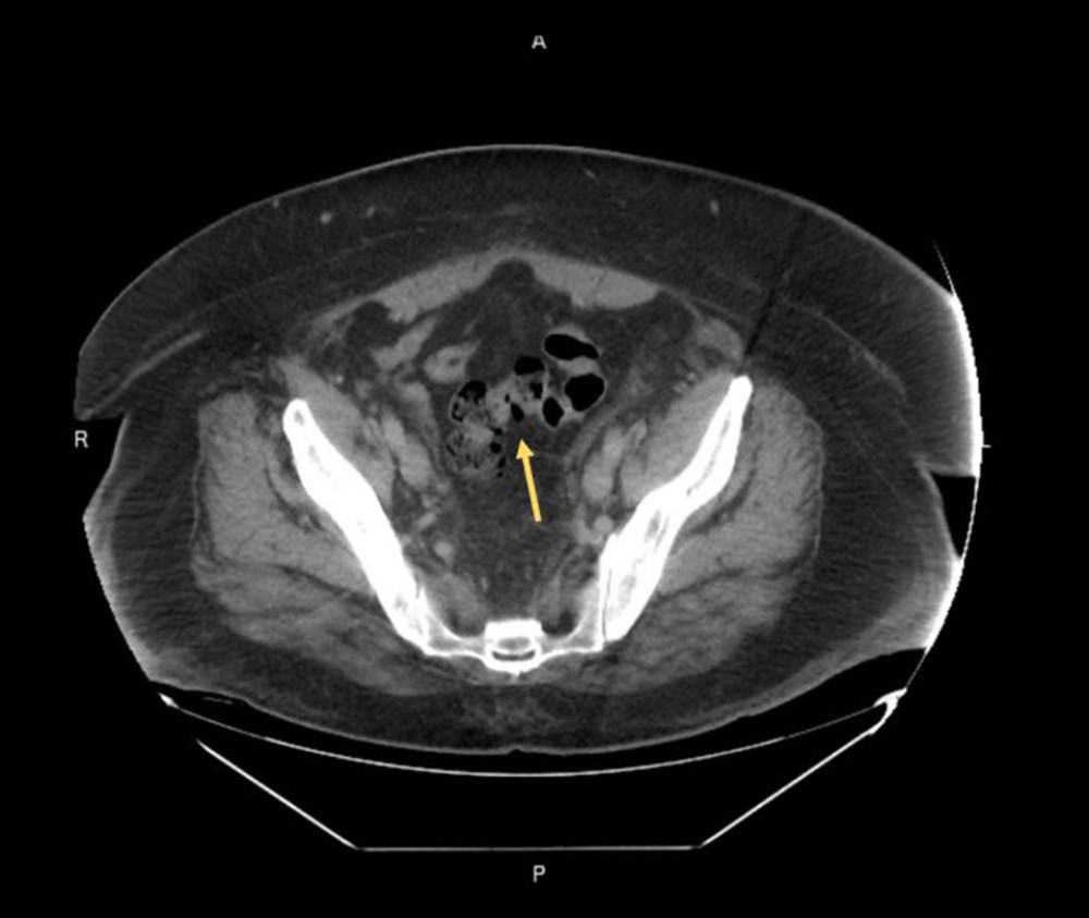 CT of abdomen and pelvis shows air-filled diverticula (yellow arrow) of the sigmoid colon.